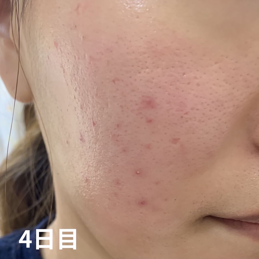 ビーソフテン ローション(医薬品)/持田製薬/その他を使ったクチコミ（2枚目）