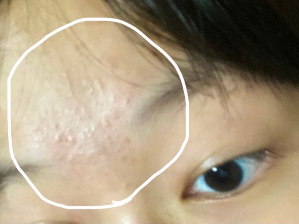 薬用アクネコントロール フレッシュ ローション/DHC/化粧水を使ったクチコミ(2枚目)