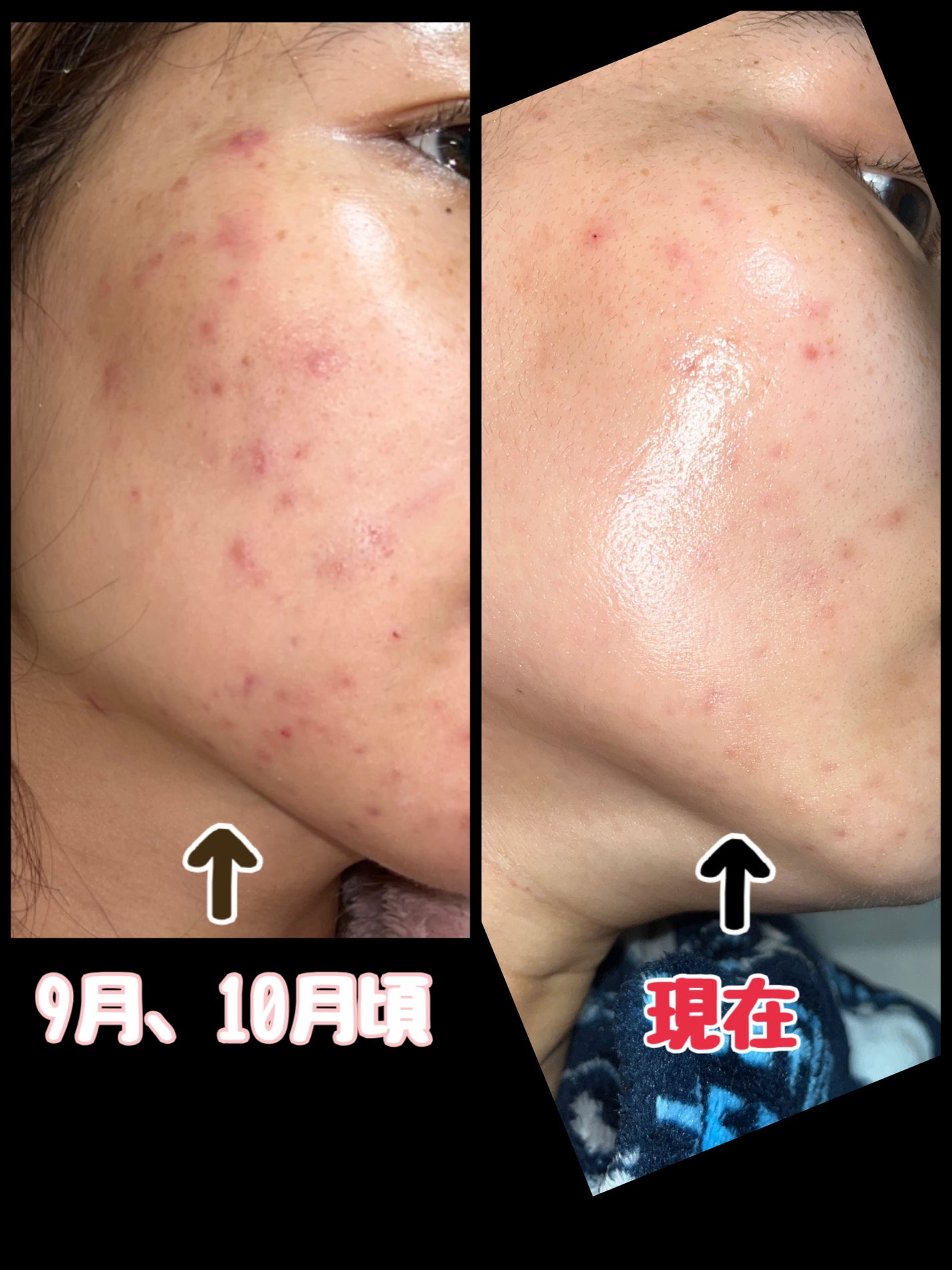 DHC ビタミンCハードカプセル/DHC/美容サプリメントを使ったクチコミ(2枚目)