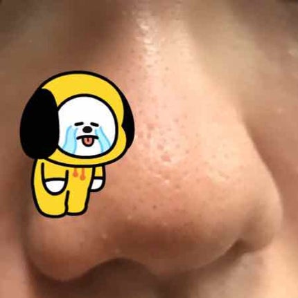 supreme_gloss_xqw on LIPS 「どなたでもいいです!!この毛穴を治せる方アドバイスください🙇..」(2枚目)