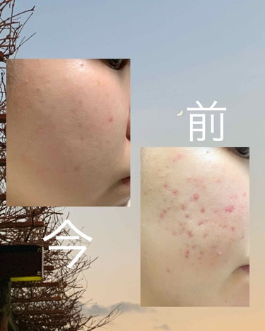 メラノCC 薬用しみ対策 美白化粧水 しっとりタイプのクチコミ「こんにちは！！8ヶ月ぶりに書きます！

だいぶマシになってきました😇✌🏻✌🏻

写真の『前』と.....」（1枚目）