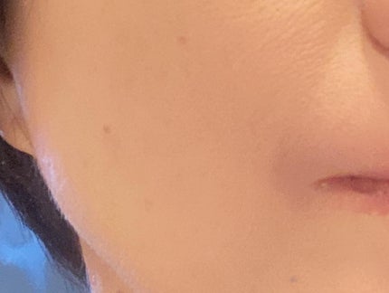 るいめい on LIPS 「.🍀メディアリュクスパウダーファンデーション色でカバーするので..」(4枚目)