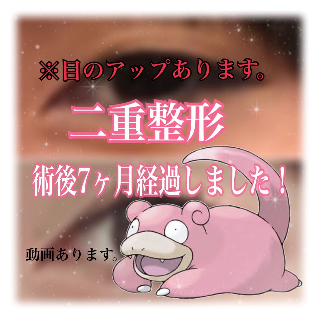 サチヲ on LIPS 「・・❤︎二重整形(埋没法)❤︎・・今年の4月に埋没法にて二重整..」(1枚目)