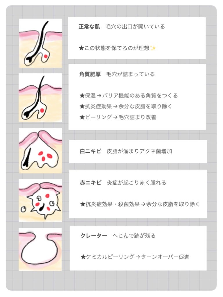 なな on LIPS 「ニキビの状態とそれぞれのニキビ別スキンケア方法✨ニキビはお肌の..」(2枚目)