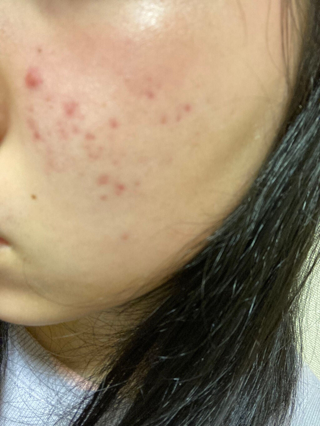 さくら on LIPS 「コロナ禍でマスク荒れが本当に酷く、ニキビができ、ニキビ跡もでき..」(3枚目)