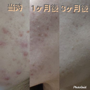 ぴーの on LIPS 「大きなニキビがたくさんできる！同じ場所に何回もできる！ニキビ対..」（2枚目）