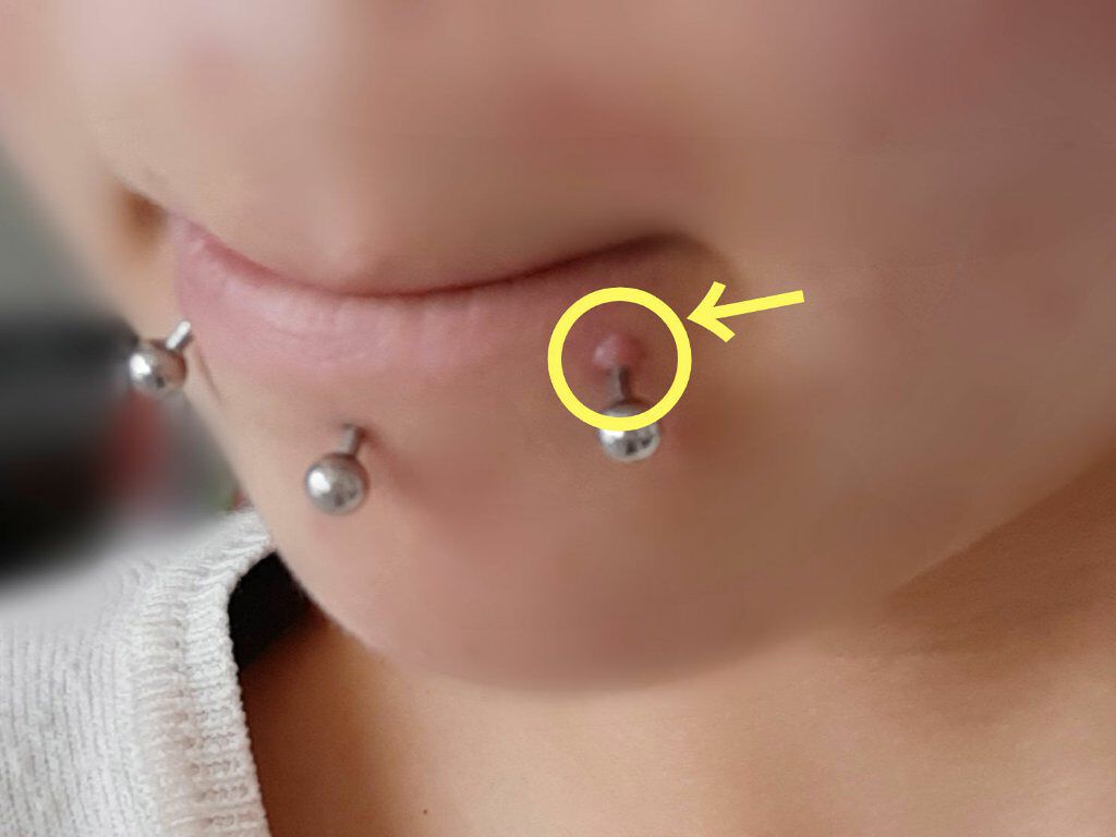 ベトネベートN軟膏AS(医薬品)/第一三共ヘルスケア/その他を使ったクチコミ(2枚目)