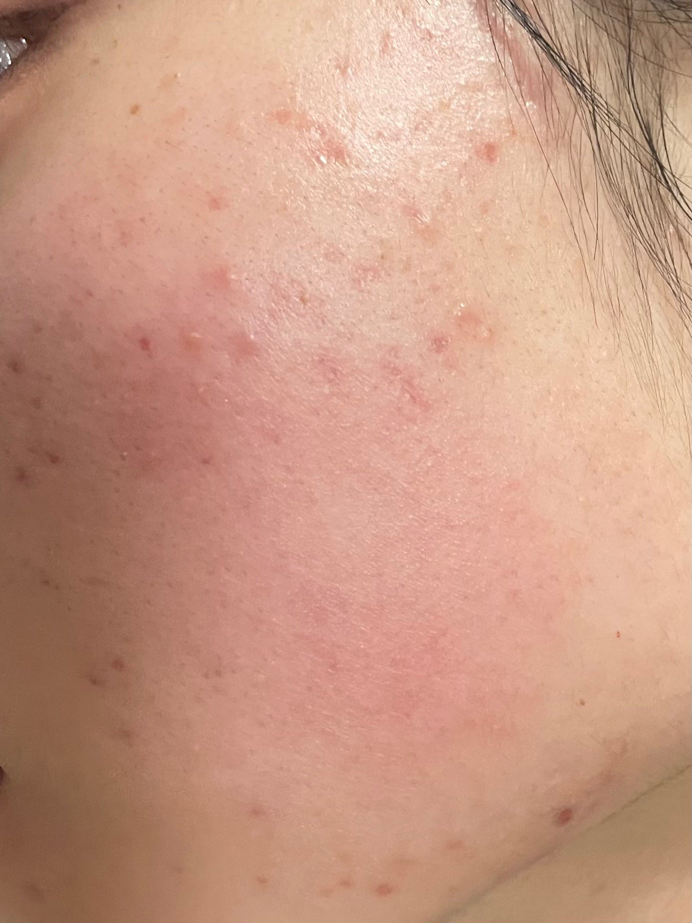 ペアアクネクリームW(医薬品)/ペア/その他を使ったクチコミ(4枚目)