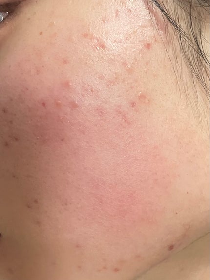 ペアアクネクリームW(医薬品)/ペア/その他を使ったクチコミ(4枚目)