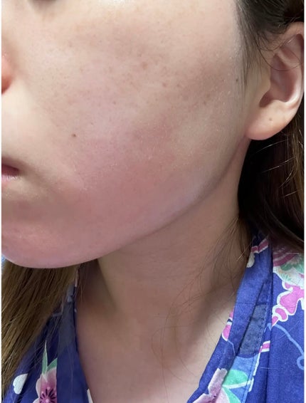 ディープブラック アクアモイスチャー シートマスク/ALFACE+/シートマスク・パックを使ったクチコミ(3枚目)