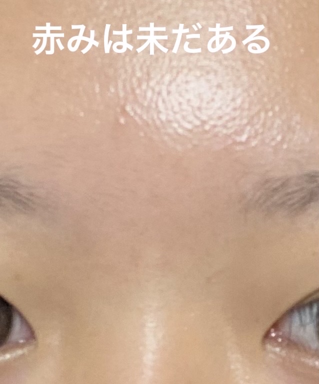 マンデリック インテンシブ 18%セラム/DR.WU/美容液を使ったクチコミ（3枚目）