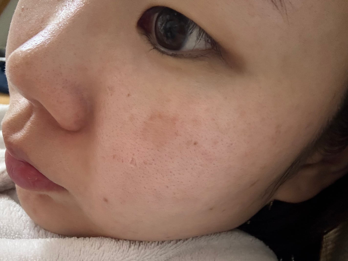 maa on LIPS 「コロナ禍で肌が荒れて、ニキビ大量発生から早4年過ぎこの毛穴開き..」(3枚目)