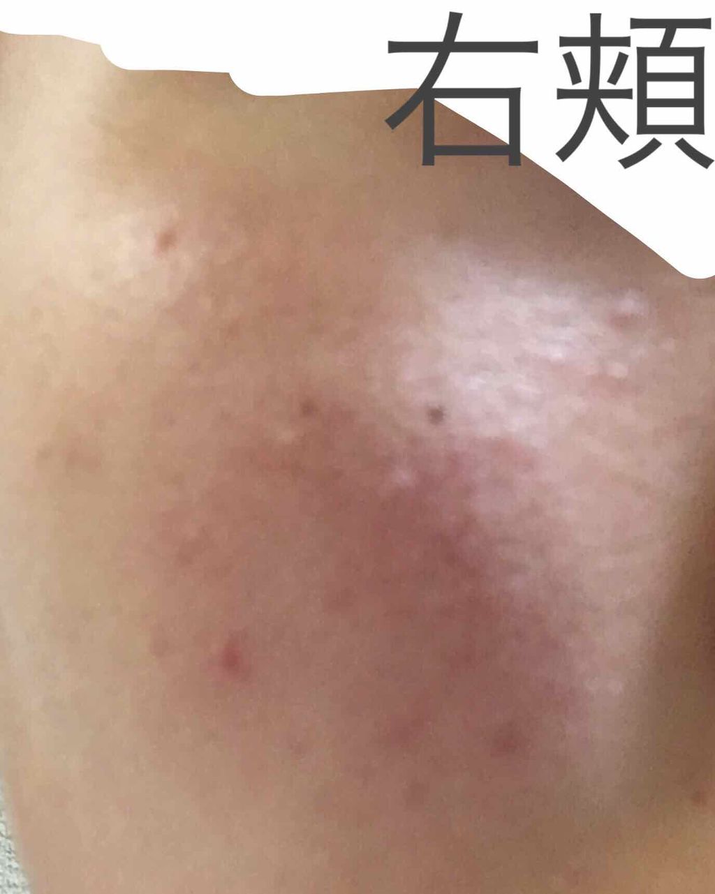 ノブ A アクネソープ/NOV/洗顔石鹸を使ったクチコミ(3枚目)