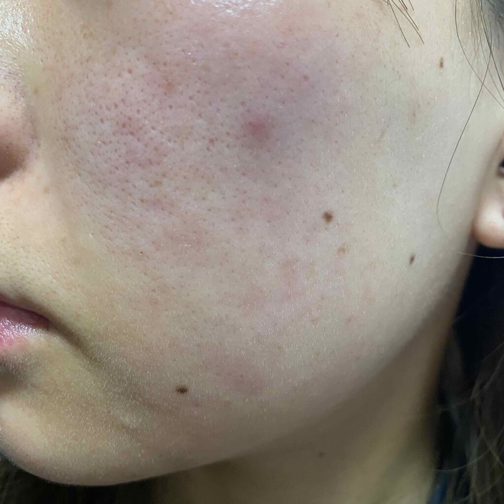 ゼビアックス(医薬品)/マルホ株式会社/その他を使ったクチコミ（1枚目）