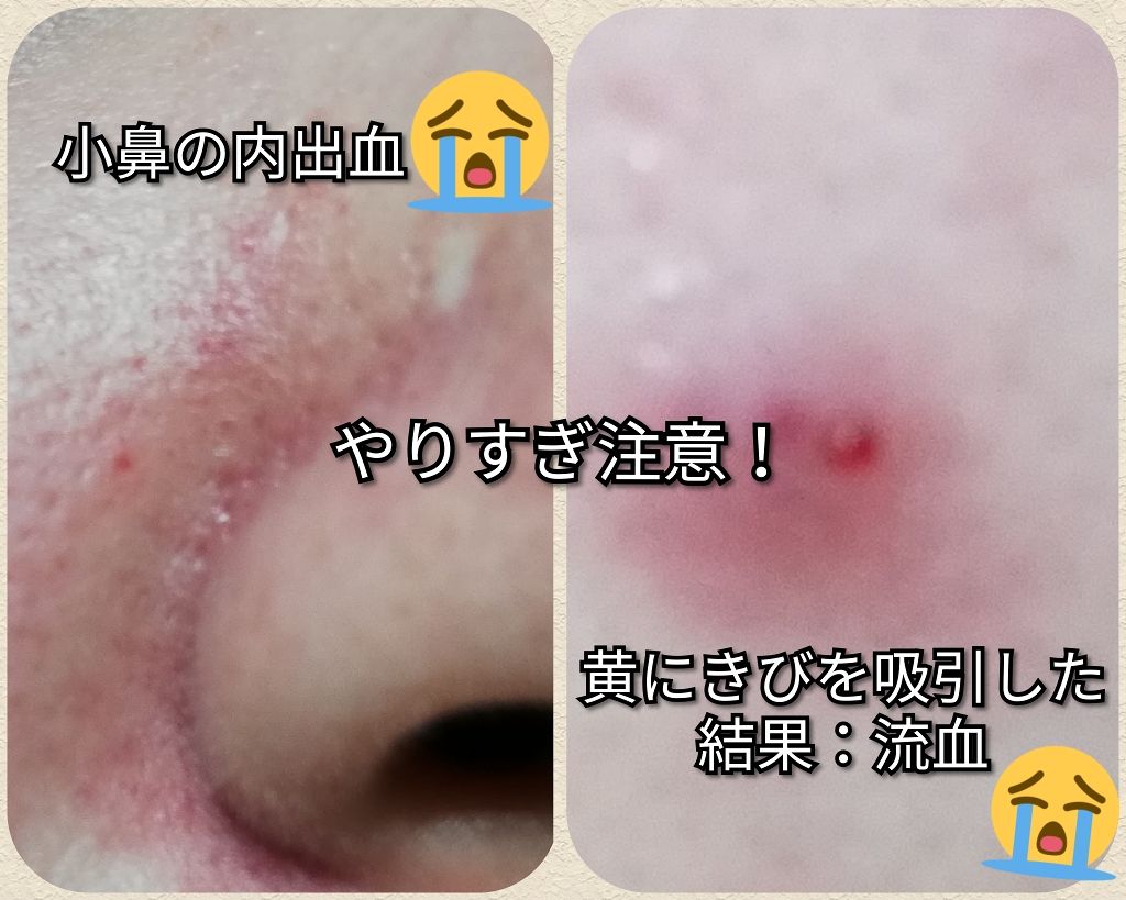 毛穴吸引クリーナー/美顔器・マッサージを使ったクチコミ（3枚目）