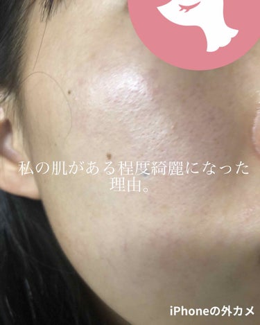 肌ラボ 白潤 薬用美白化粧水のクチコミ「赤みやべえけど！！！
加工なしのお肌見せつけてしまった、、、🙃
でも毛穴が開きまくり赤みもすご.....」（1枚目）