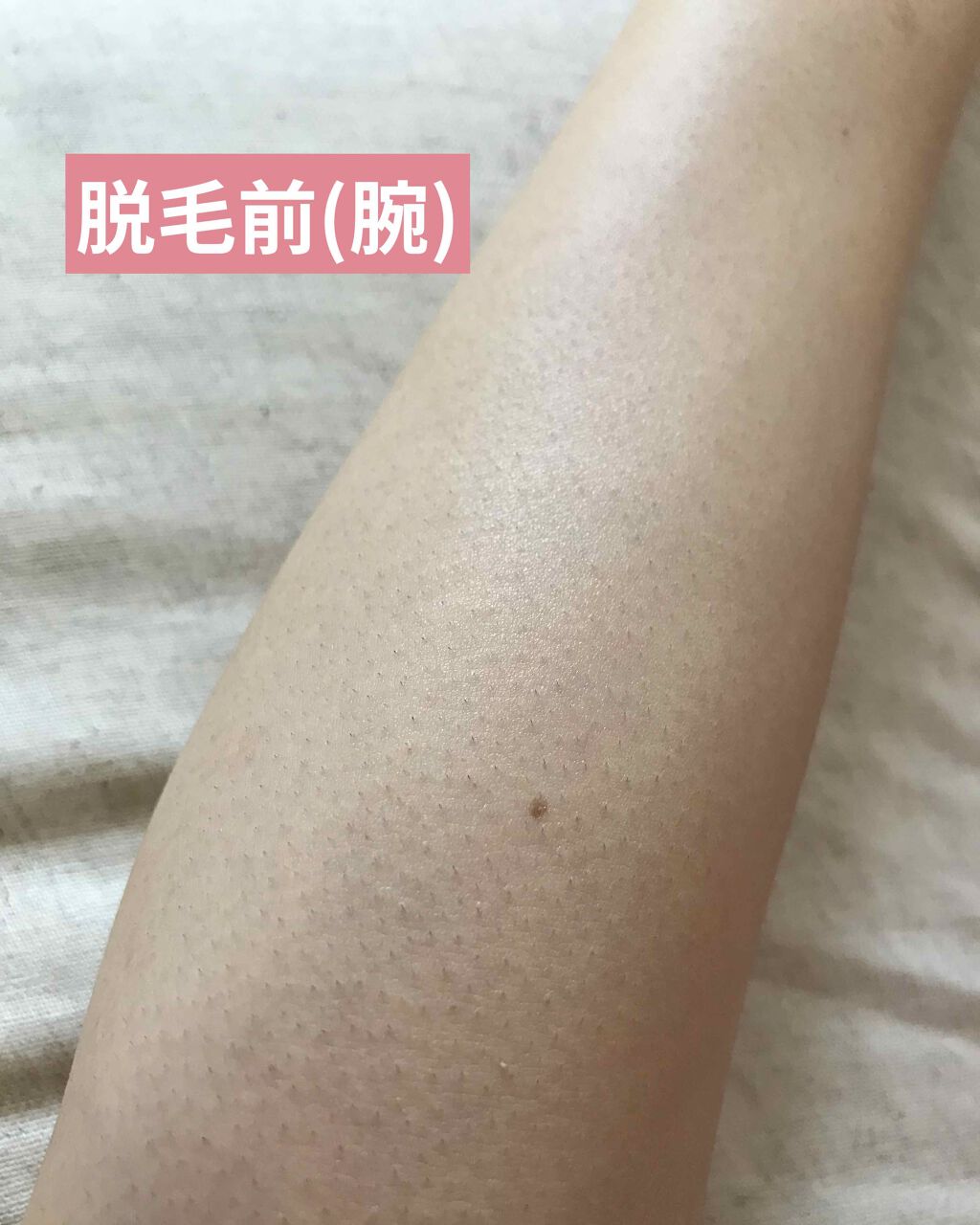 光美容器KE-NON(ケノン)/エムテック/家庭用脱毛器を使ったクチコミ(2枚目)