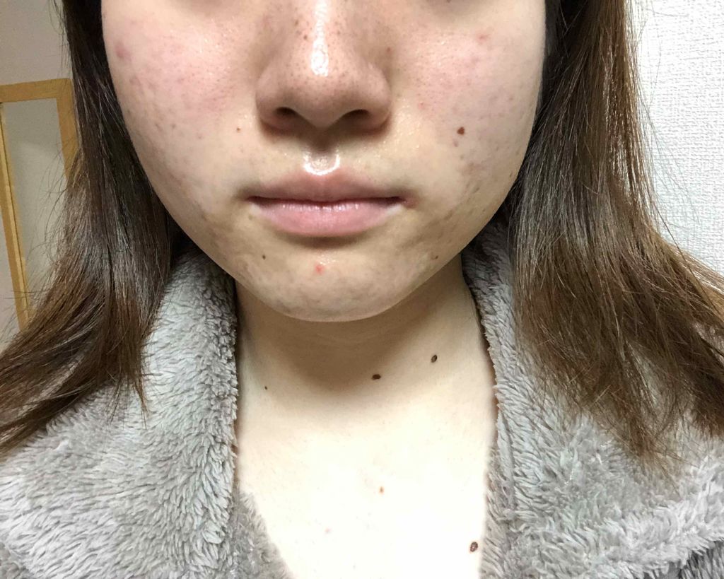 マンスリースキンケアプログラム(旧)/APEX/スキンケアキットを使ったクチコミ(2枚目)