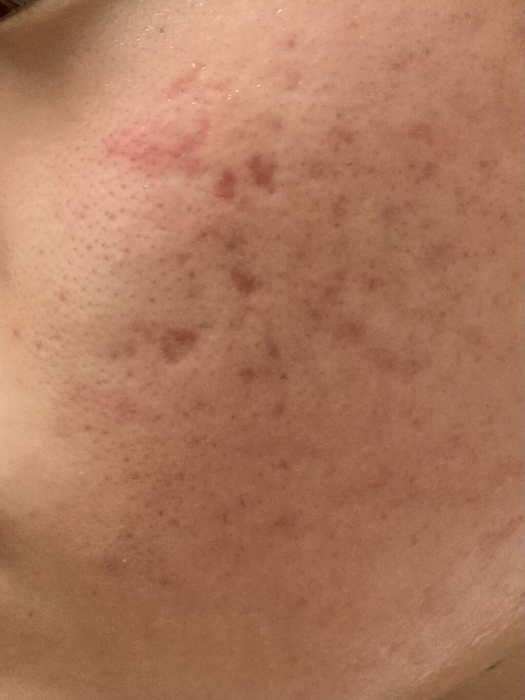 エピデュオゲル/マルホ株式会社/その他を使ったクチコミ（3枚目）