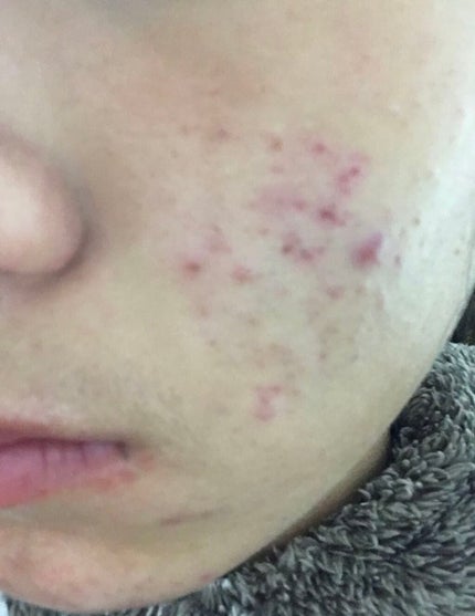 ニキビあとケアジェル/アットノン/その他スキンケアを使ったクチコミ(3枚目)