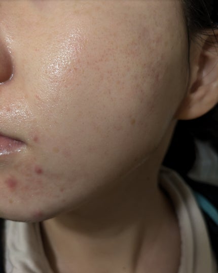 miina@汚肌工事録⚠️ on LIPS 「11/12の#汚肌工事録今見ると変な荒れ方してます😂..」(2枚目)