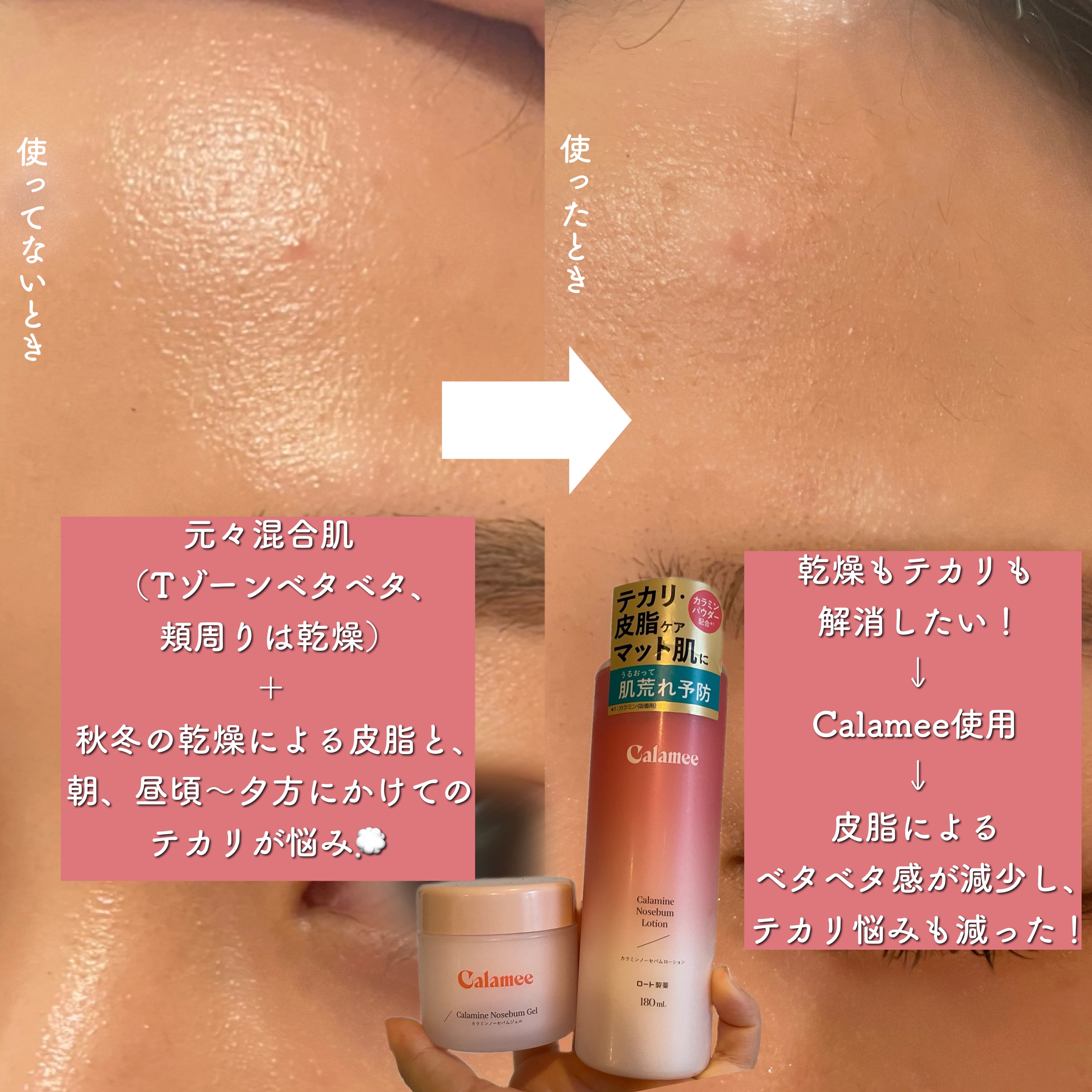 カラミー カラミンノーセバムジェル/Calamee/フェイスクリームを使ったクチコミ（2枚目）