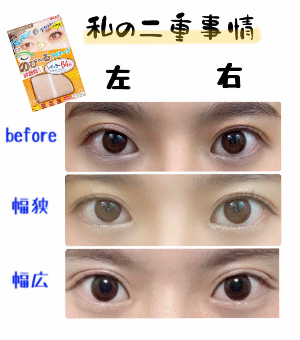 のび るアイテープ Daisoの口コミ 超優秀 100均で買えるおすすめ二重まぶた用アイテム ご閲覧ありがとうござい By チョコの助 フォロバ100 乾燥肌 代後半 Lips