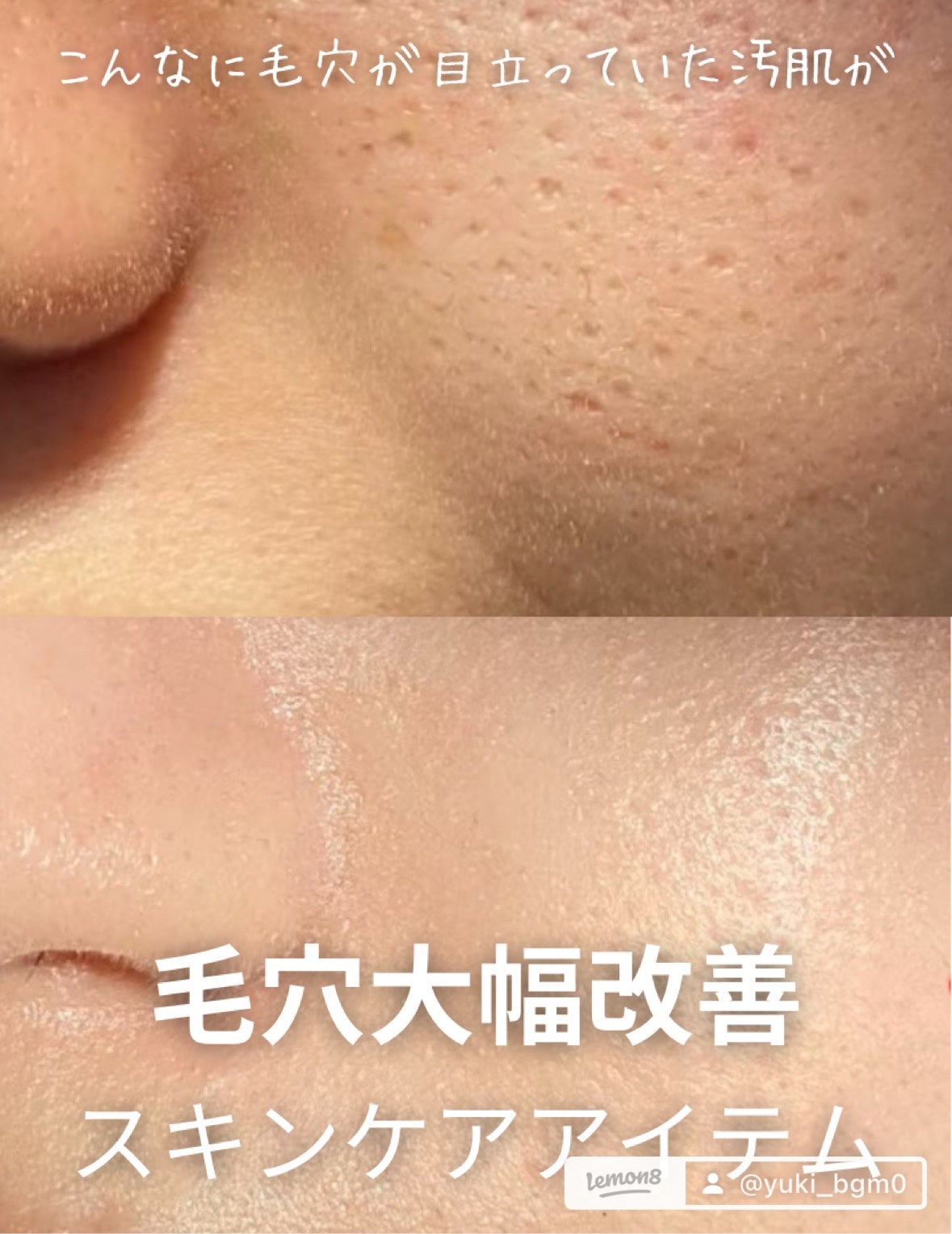 Yuki. on LIPS 「2週間でも大幅改善/毛穴全消しスキンケアITEMお目汚しすみま..」(1枚目)