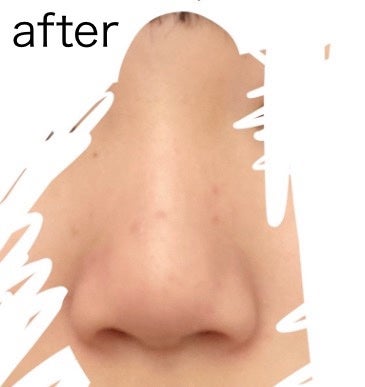 âð€ð𪜠on LIPS ãçããããã«ã¡ã¯!錻ãå°ããããæ¹æ³ã§ããããã¡ããã®éŒ»ããã..ãïŒ6æç®ïŒ