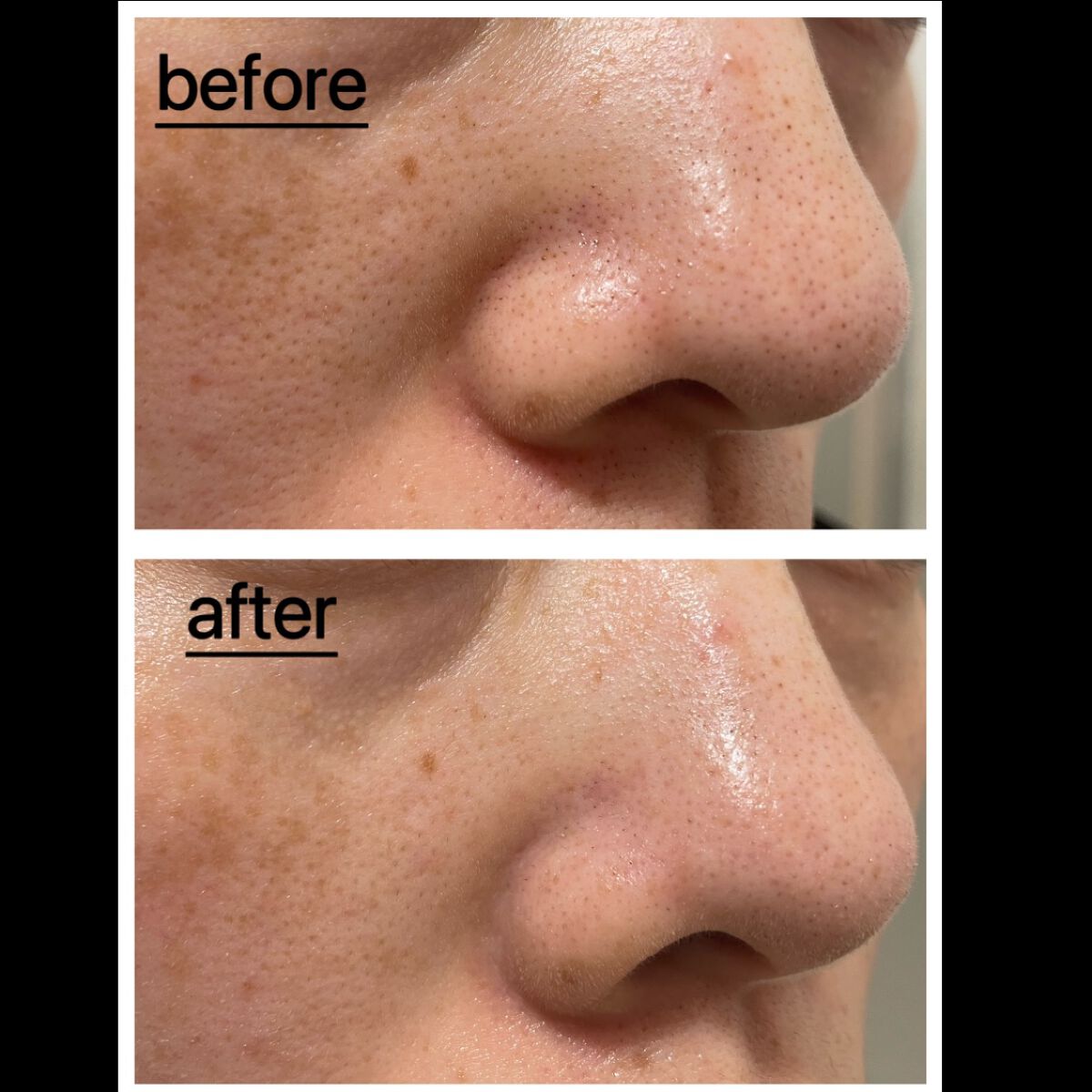 カロテンIPMP(TM) とろけるクレンジングバーム /APRILSKIN/クレンジングバームを使ったクチコミ(5枚目)