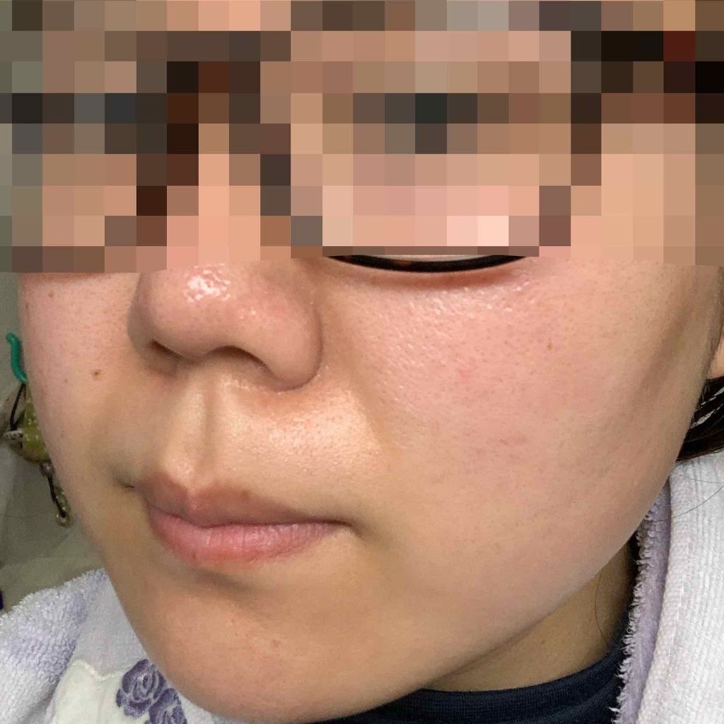 カンダンバリア エッセンス/d プログラム/美容液を使ったクチコミ（2枚目）