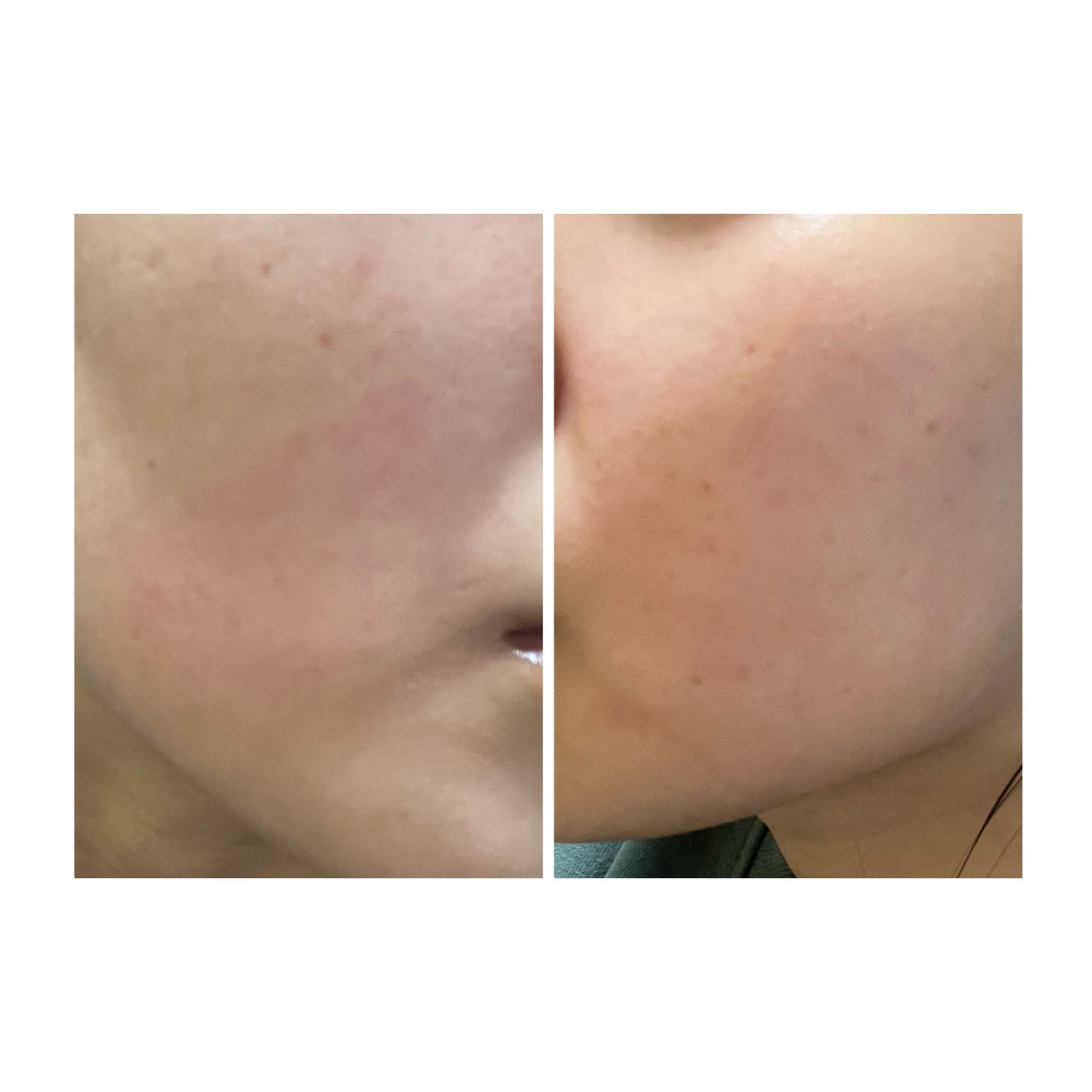 ぽむ on LIPS 「2023.9.13皮膚科に受診 エピデュオとヘパリン処方1枚目..」(2枚目)