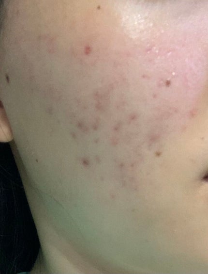 A アクネジェル/NOV/美容液を使ったクチコミ(3枚目)