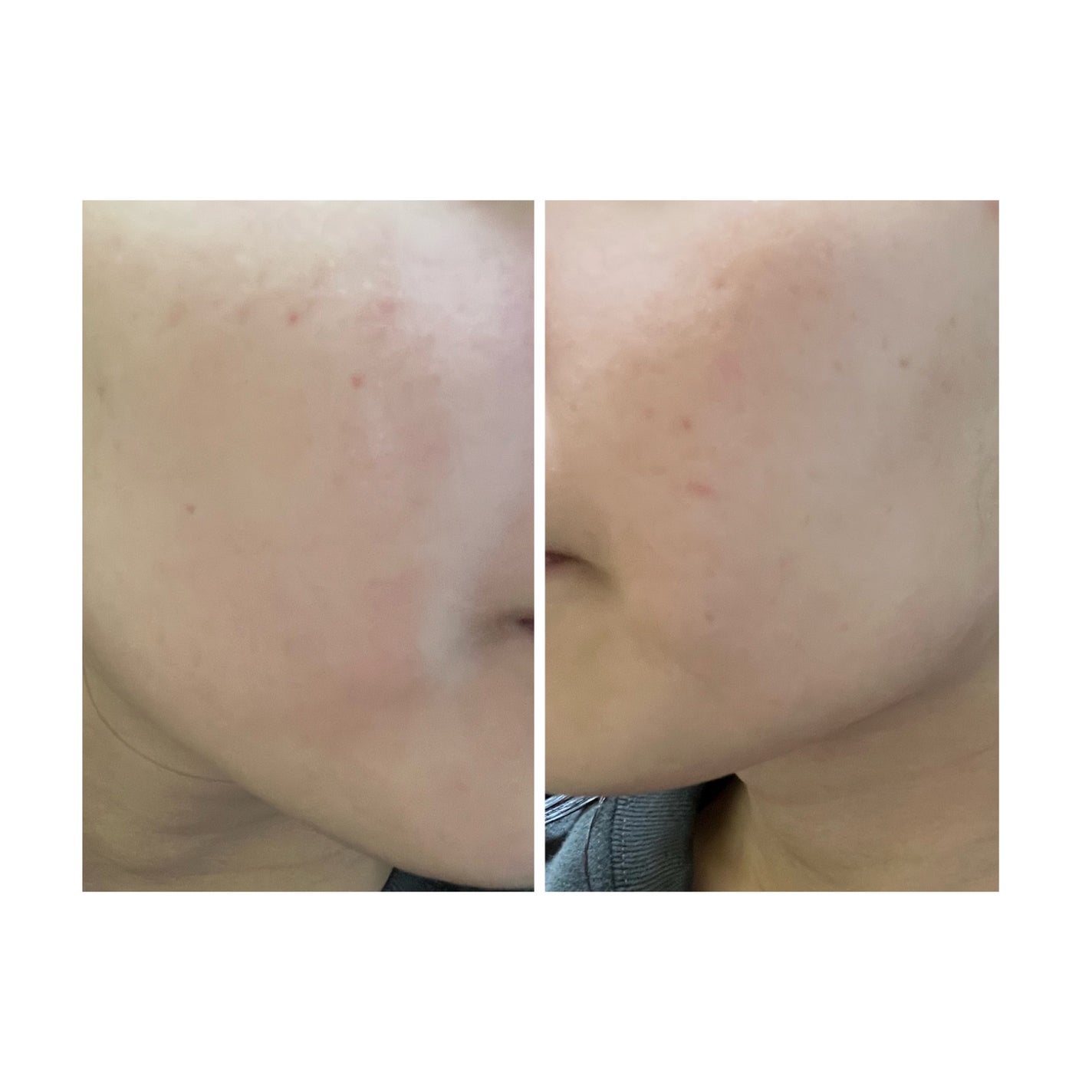 ぽむ on LIPS 「2023.9.13皮膚科に受診 エピデュオとヘパリン処方1枚目..」(4枚目)