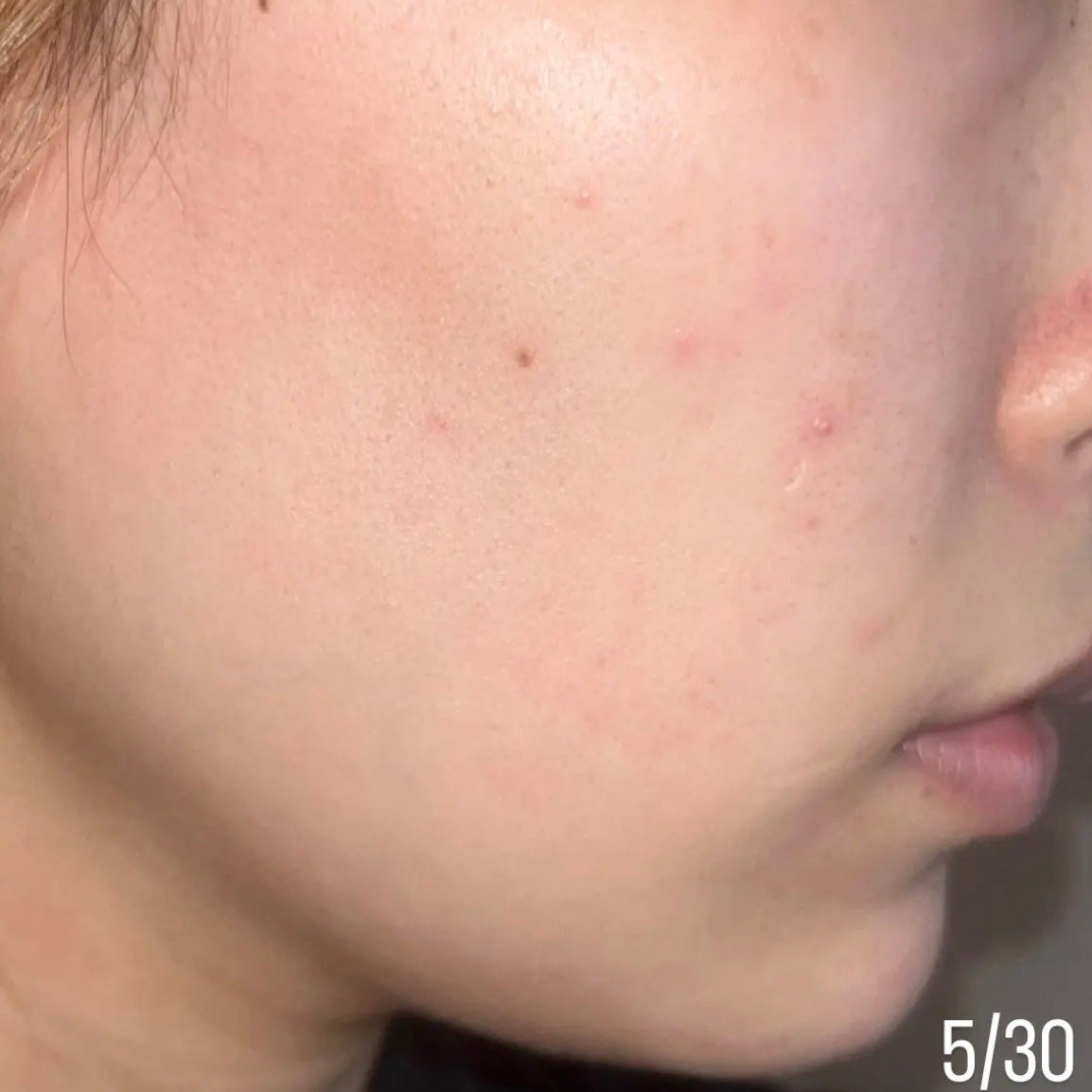 ペアアクネクリームW(医薬品)/ペア/その他を使ったクチコミ(5枚目)