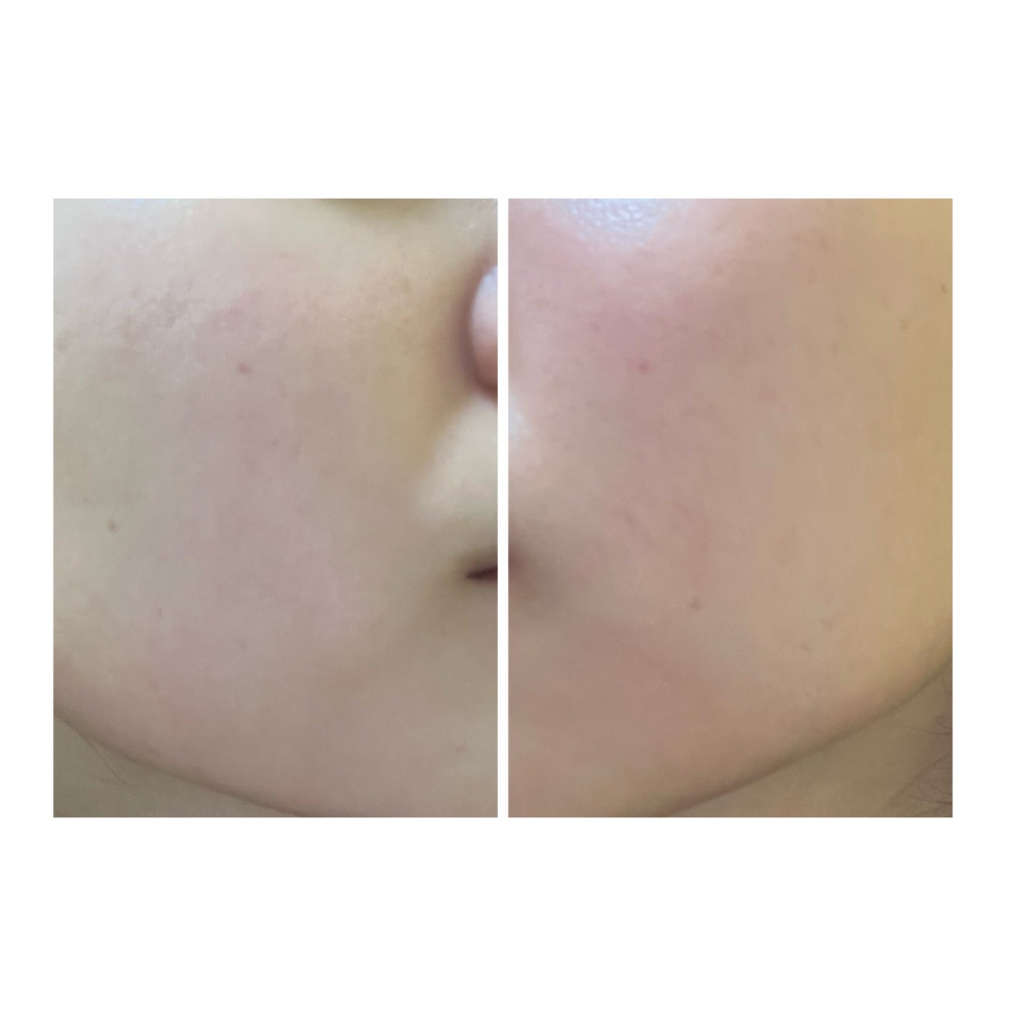 ぽむ on LIPS 「2023.9.13皮膚科に受診 エピデュオとヘパリン処方1枚目..」(5枚目)