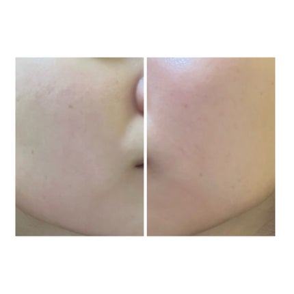 ぽむ on LIPS 「2023.9.13皮膚科に受診 エピデュオとヘパリン処方1枚目..」(5枚目)