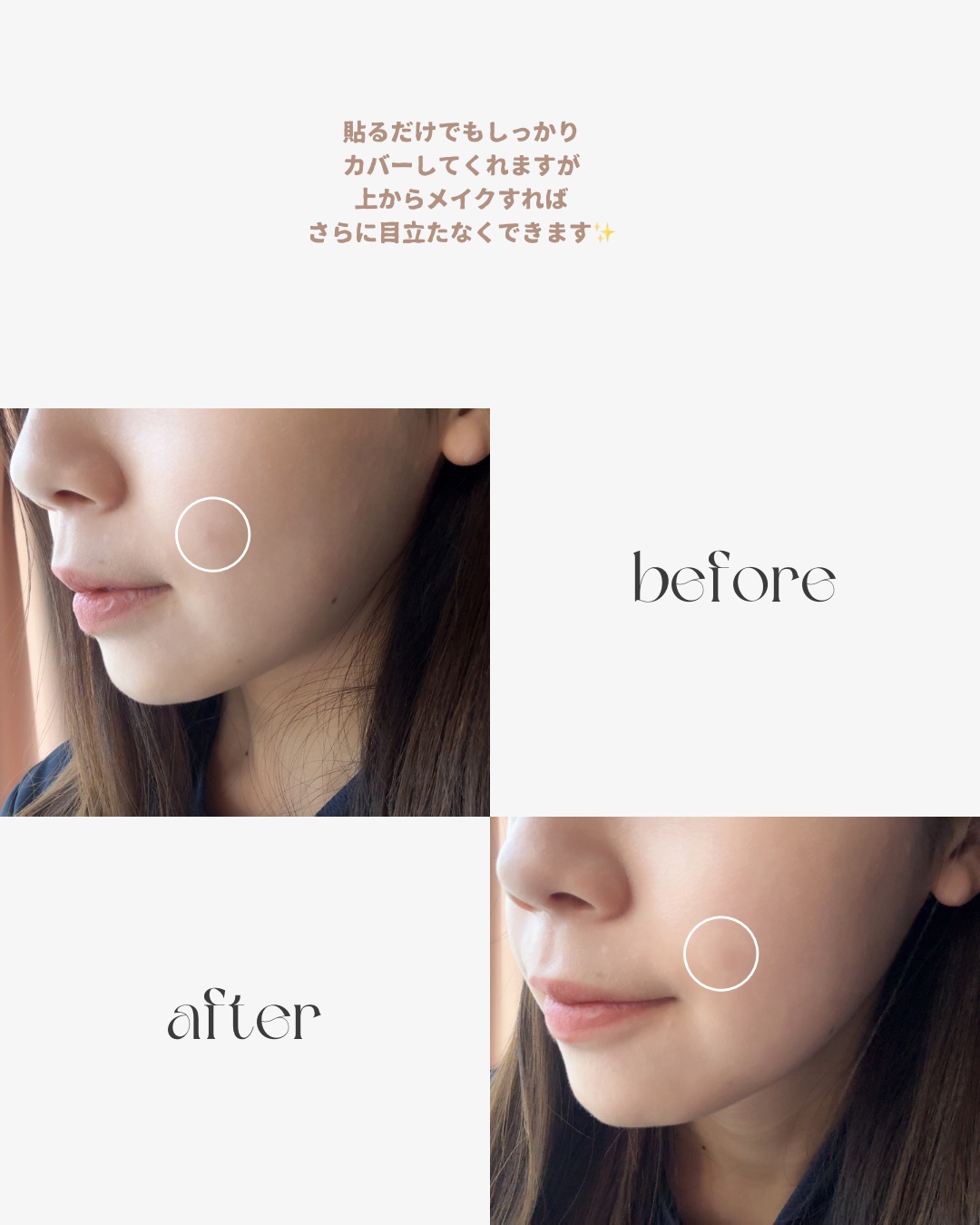 クリアパッチ/Angelab/にきびパッチを使ったクチコミ（3枚目）