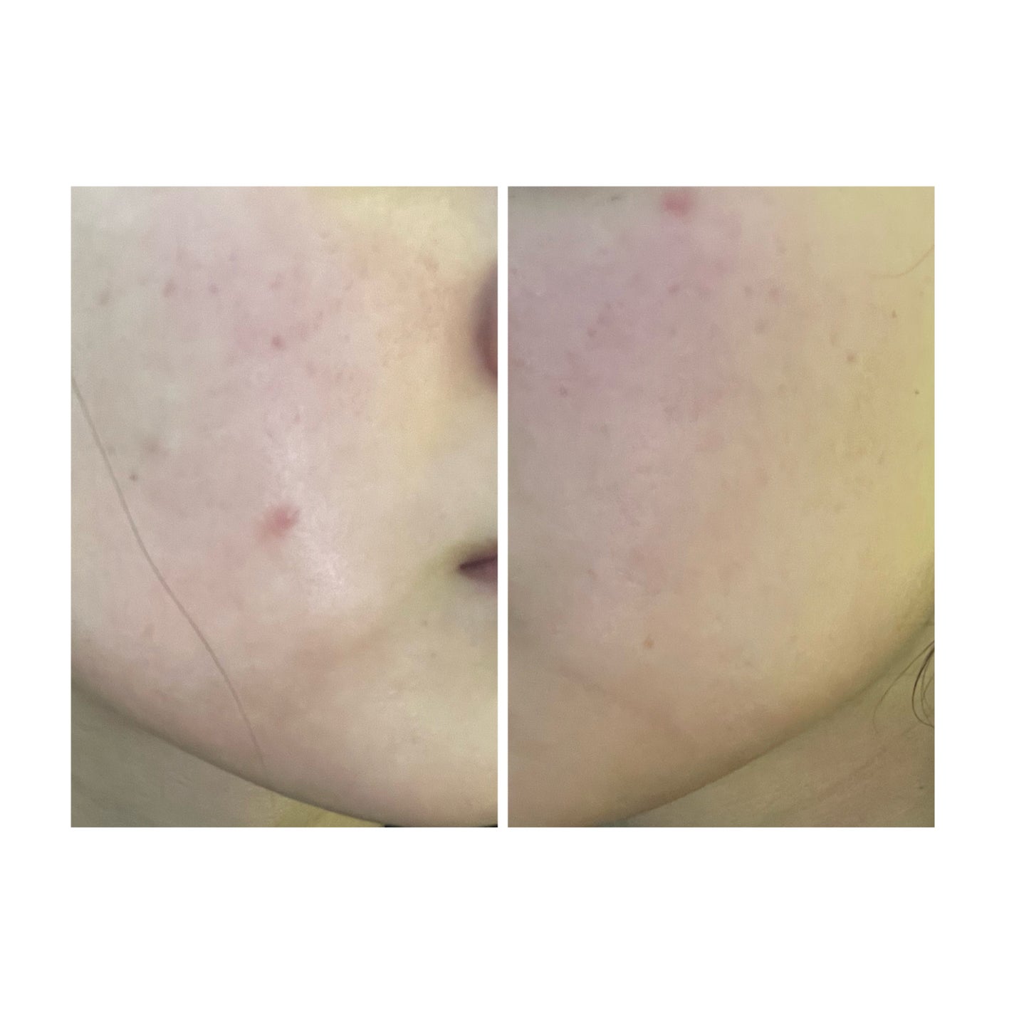 ぽむ on LIPS 「2023.9.13皮膚科に受診 エピデュオとヘパリン処方1枚目..」(4枚目)