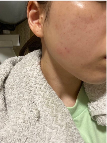 トラブルリペア リキッド/アルージェ/美容液を使ったクチコミ(1枚目)