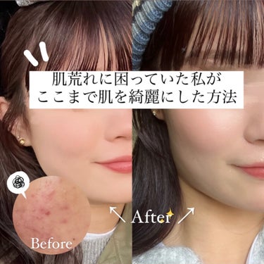 汚肌だった私がここまで肌を綺麗にした方法💆🏻‍♀️


みなさんこんばんは☺️🤍
私の投稿をご覧いただきありがとうございます！

まず2枚目の写真をご覧ください
※とっても汚い肌が写ります。閲覧注意です