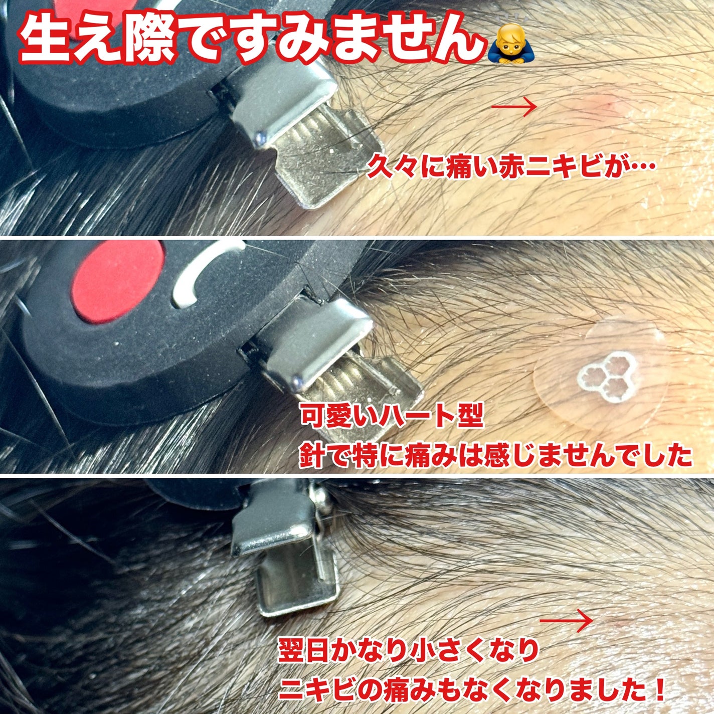 ACマグネシウムパッチ ミニ/スノーツープラス/にきびパッチを使ったクチコミ(3枚目)