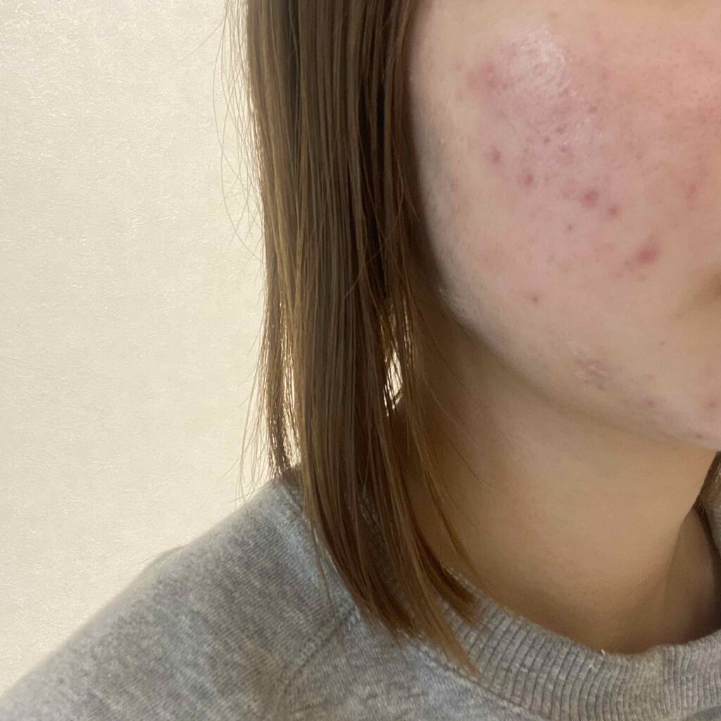 クリンダマイシンゲル(医薬品)/クラシエ薬品/その他を使ったクチコミ（1枚目）