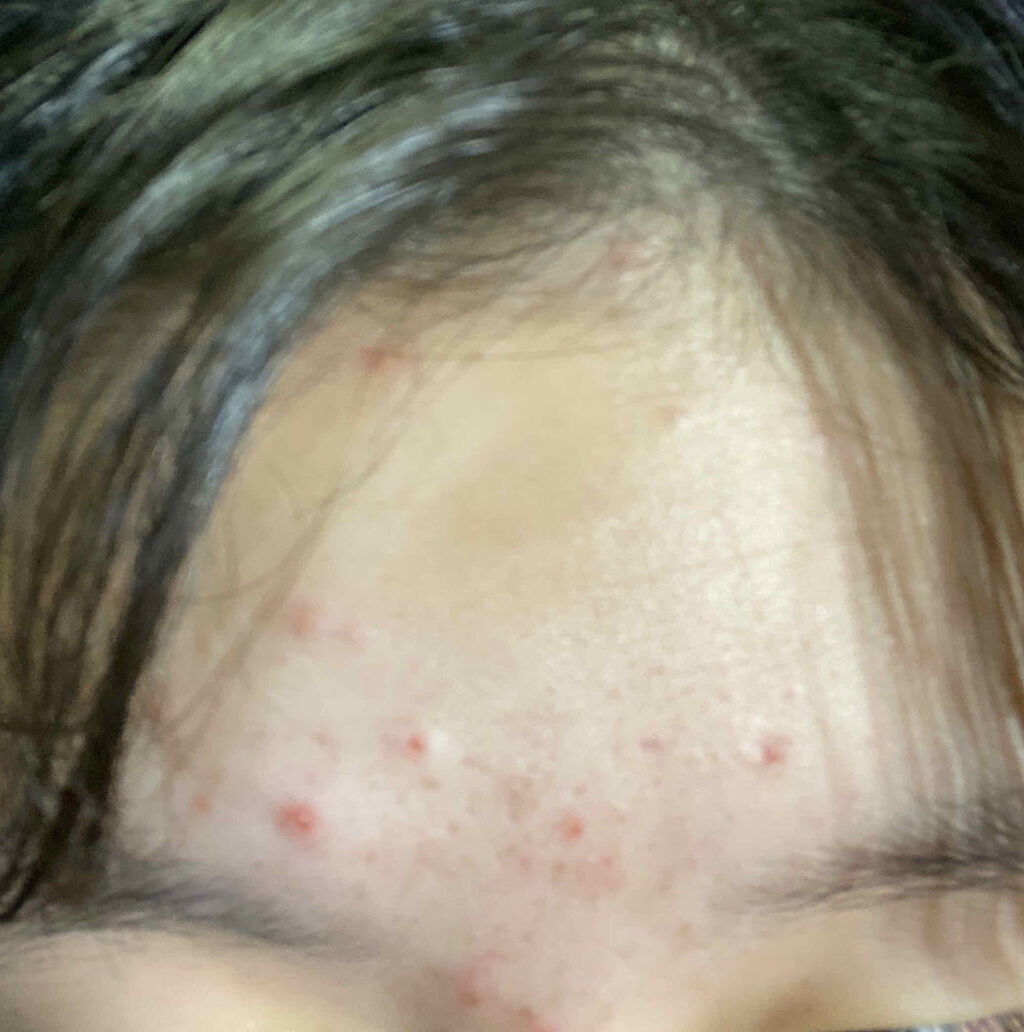 エピデュオゲル/マルホ株式会社/その他を使ったクチコミ（2枚目）