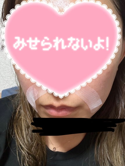 ヒアロディープパッチ/北の快適工房/シートマスク・パックを使ったクチコミ(3枚目)