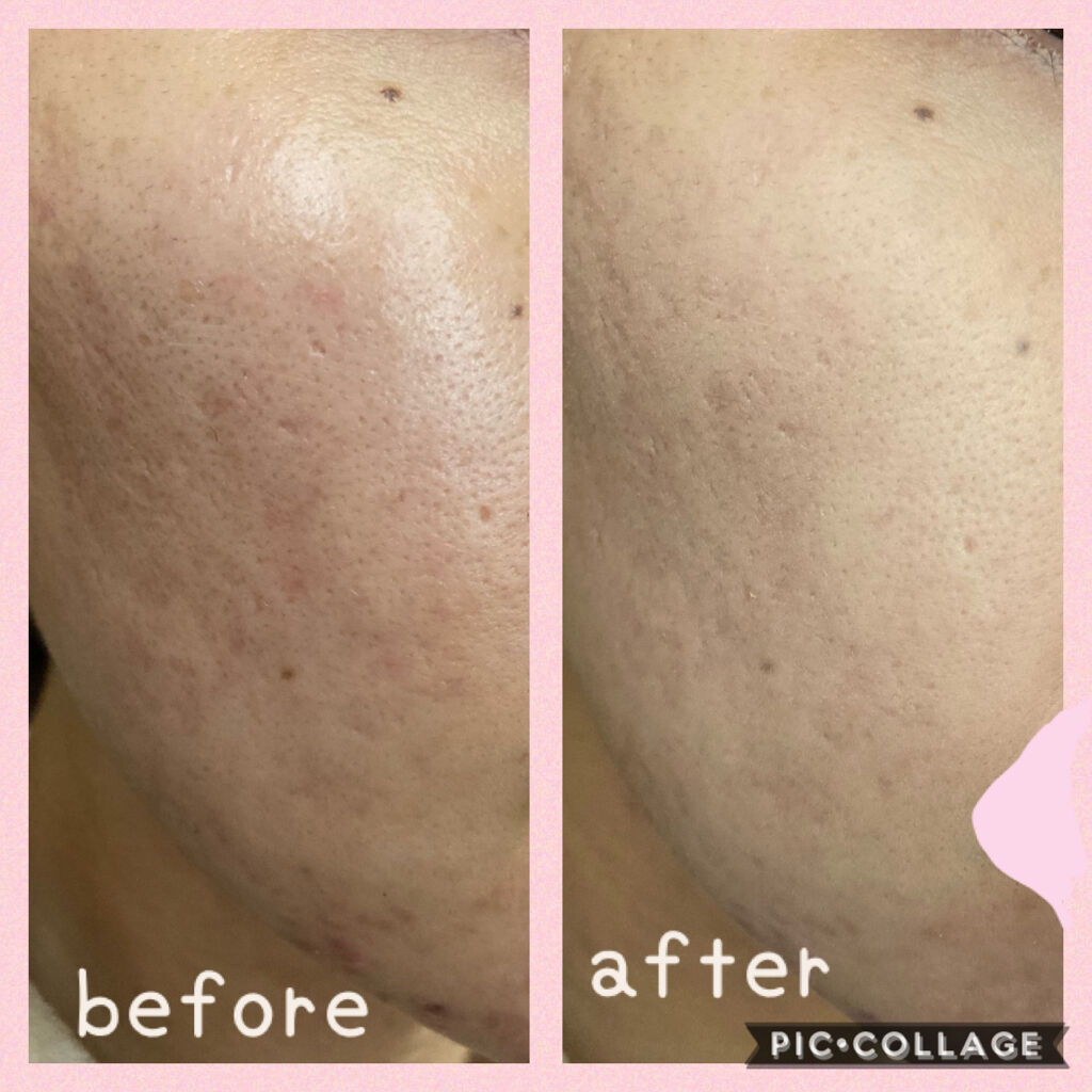 アルビオン パウダレスト/ALBION/パウダーファンデーションを使ったクチコミ（3枚目）