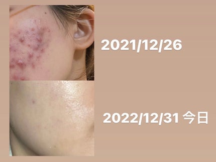 ふ on LIPS 「お久しぶりです。しばらくお肌の状態が低迷していたので、更新でき..」(1枚目)