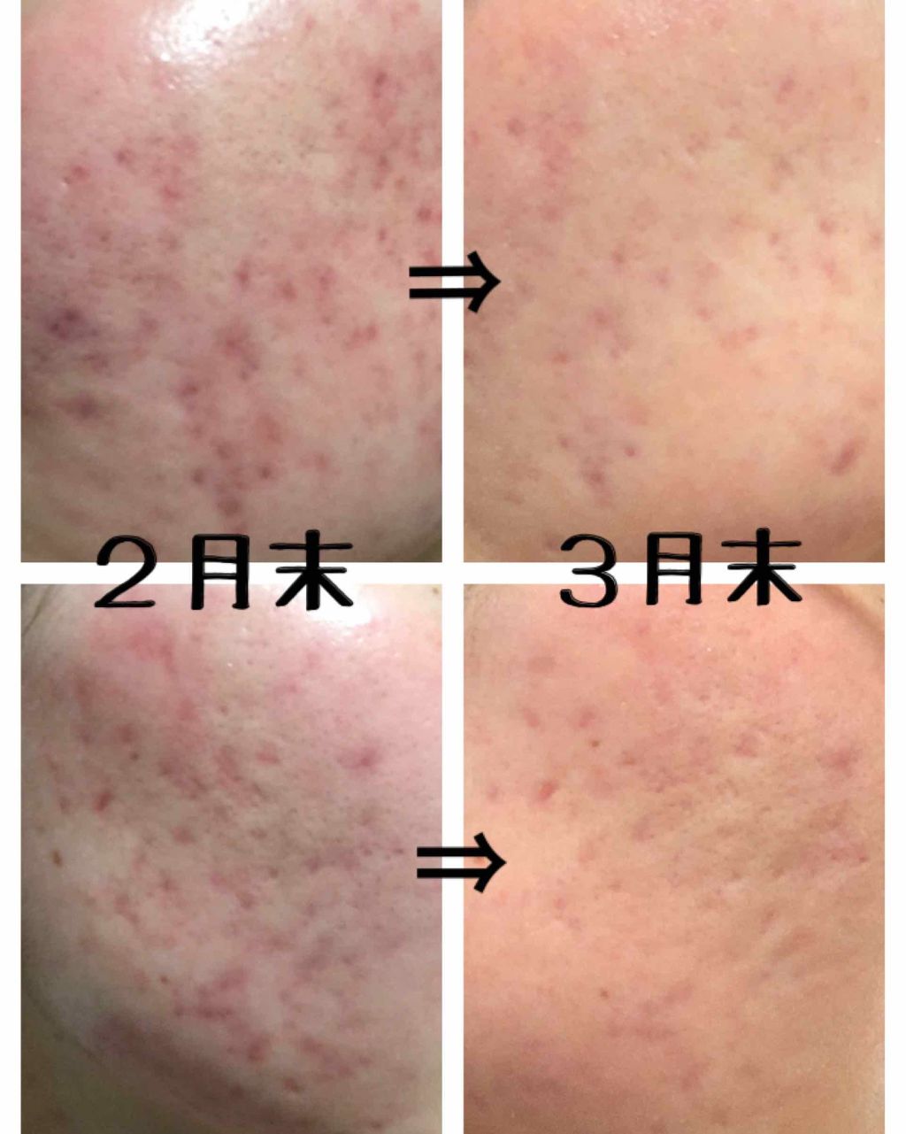 まな on LIPS 「どうも。⚠️2枚目に汚い肌の画像があります、気をつけてください..」(2枚目)