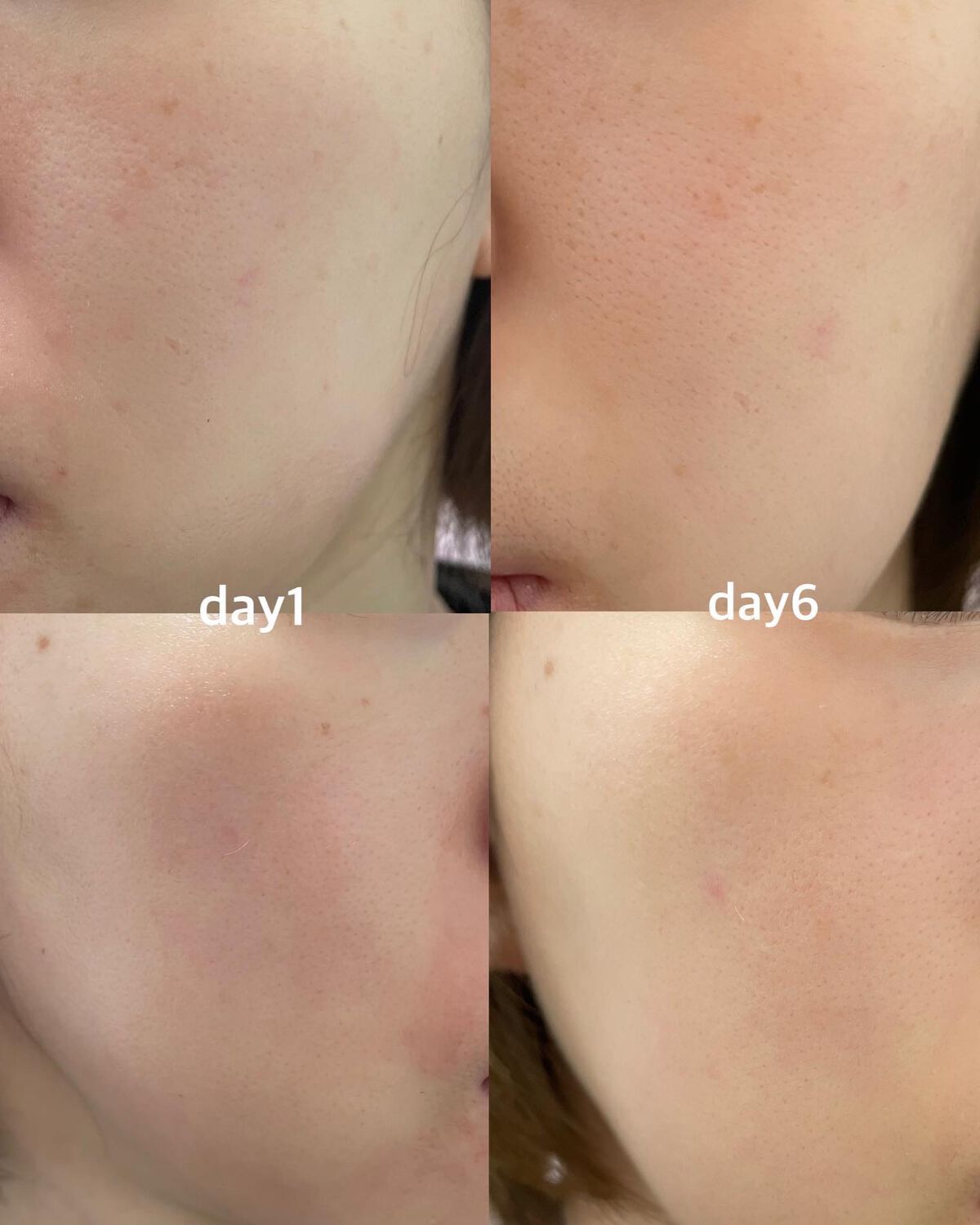 あずさ@スキンケアマニア on LIPS 「薄いシミは消えるのか?ピコスポットレポ1月半ばにUBクリニック..」(5枚目)