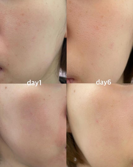 あずさ@スキンケアマニア on LIPS 「薄いシミは消えるのか?ピコスポットレポ1月半ばにUBクリニック..」(5枚目)